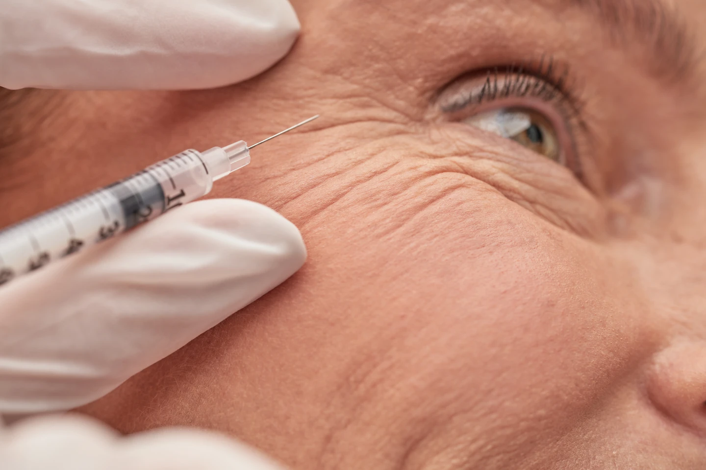 Relleno facial con ácido hialurónico