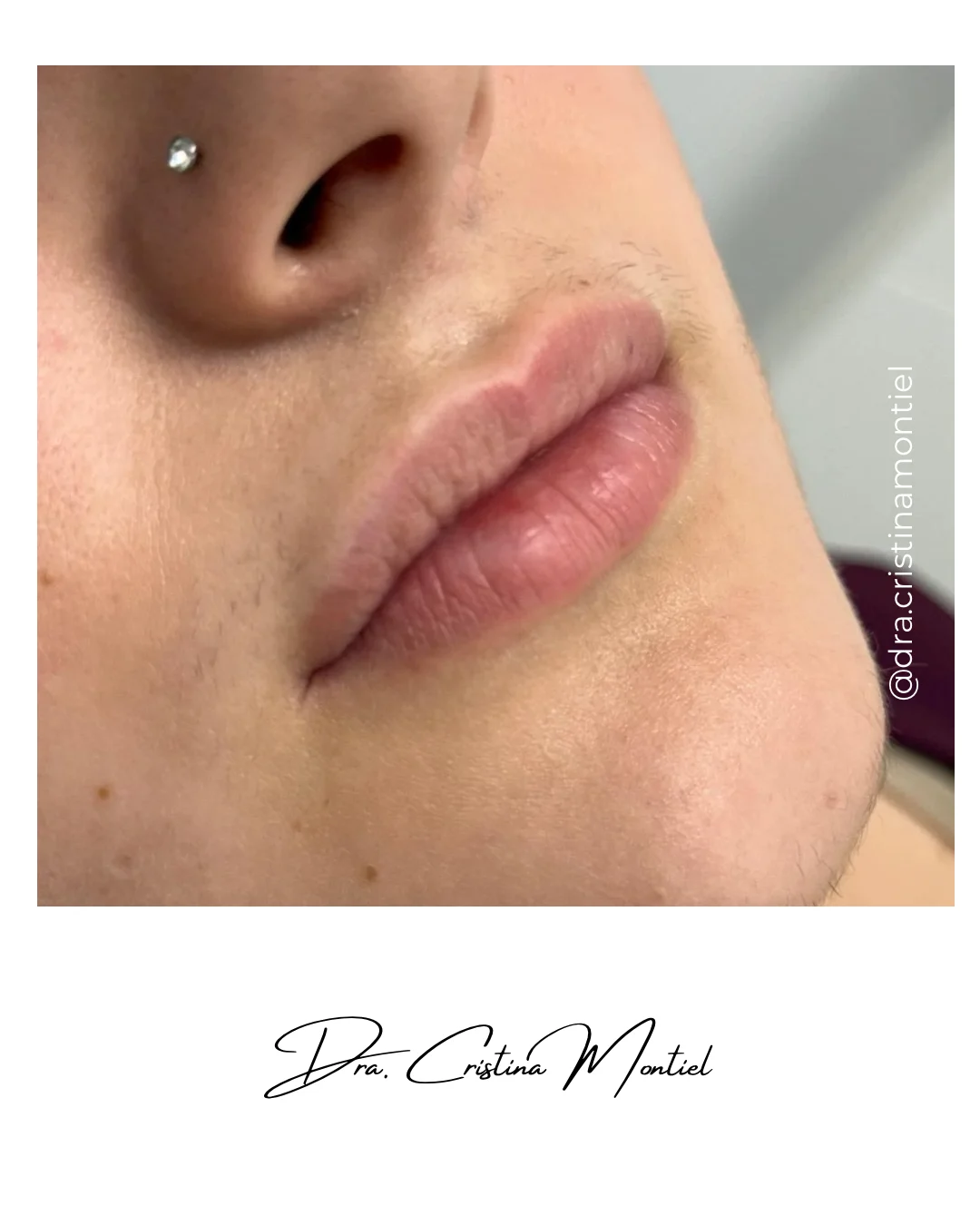 Labios antes del relleno con ácido hialurónico