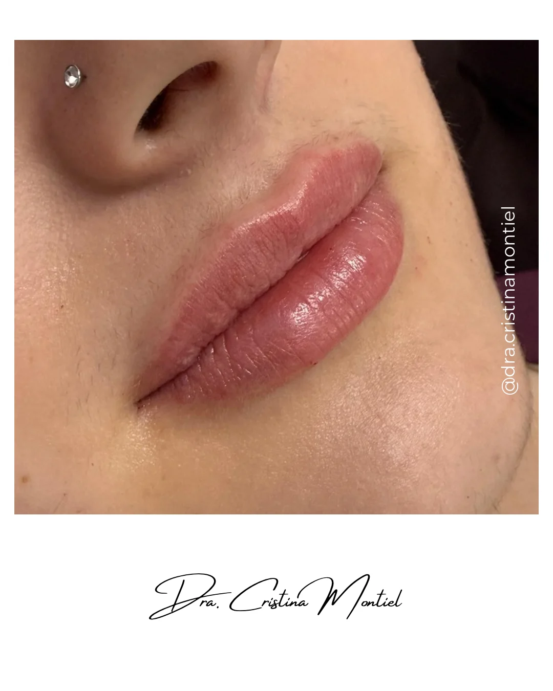 Labios después del relleno con ácido hialurónico
