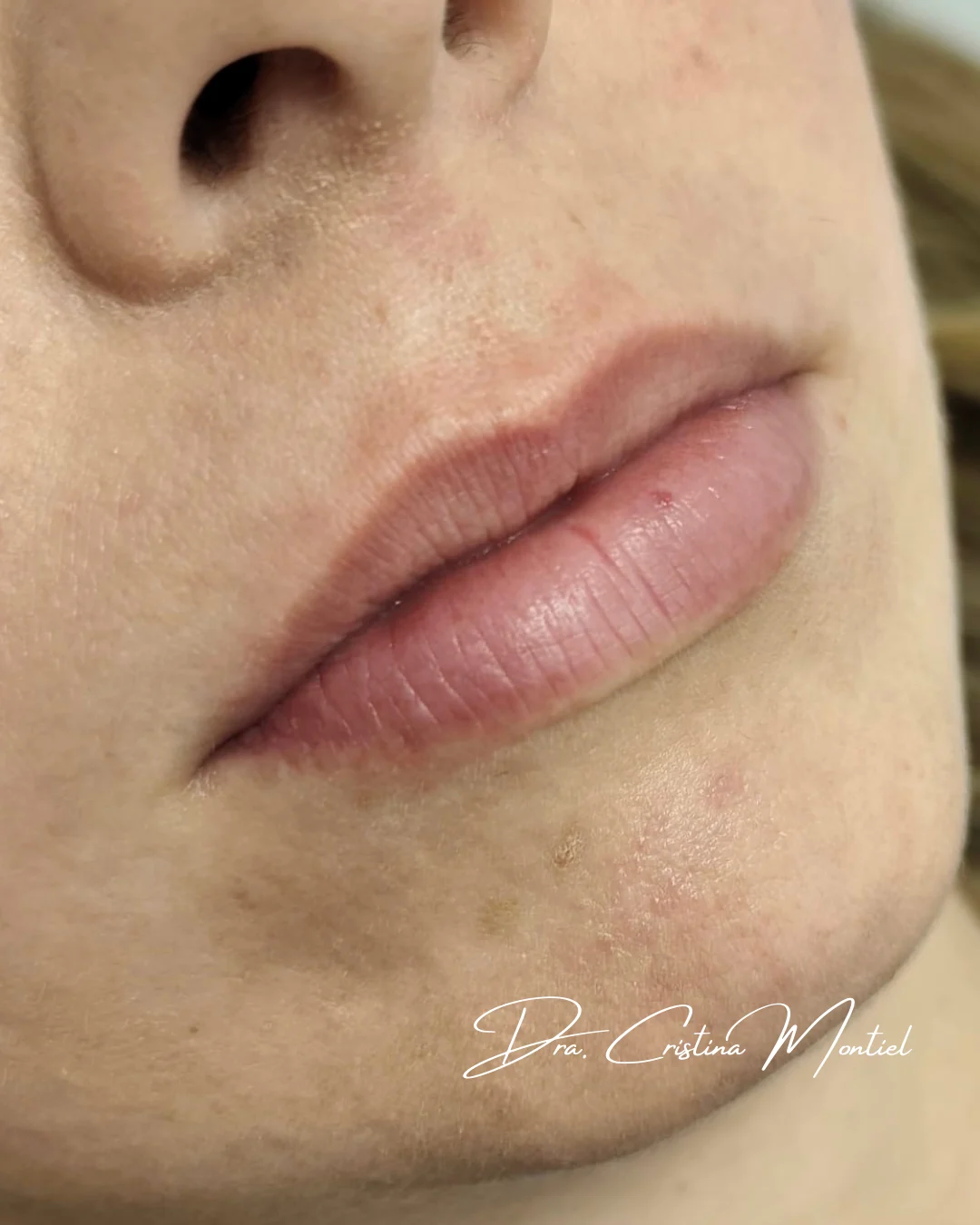 Aumento de labios — caso real, antes del tratamiento