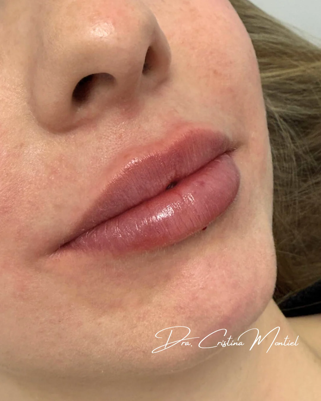 Aumento de labios — caso real, resultado después del tratamiento
