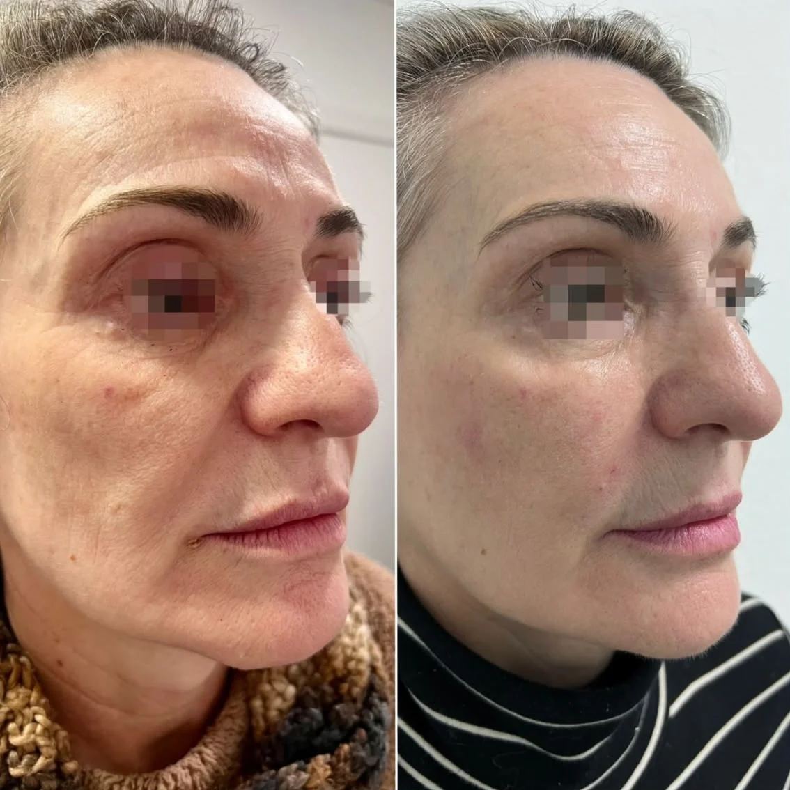 Antes y después de un tratamiento de skinbooster facial. Caso real de paciente. Resultados variables según el paciente.